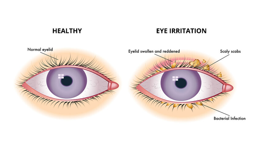 Solve your eye irritation problems