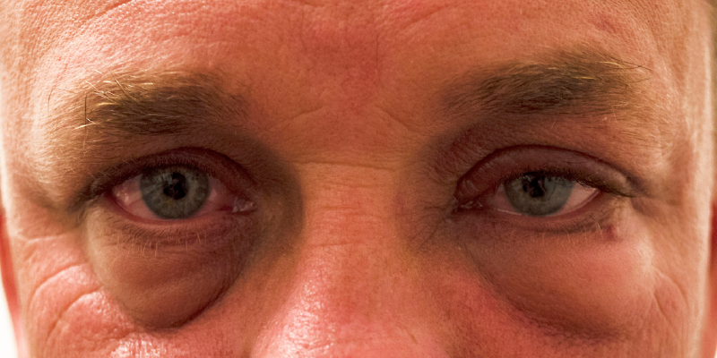 Could swollen eyes be the beginning of dry eyes?