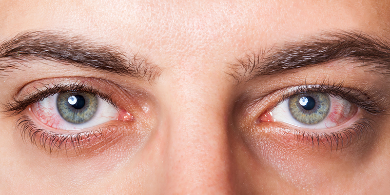 Natural Dry Eye Solutions Demystified
