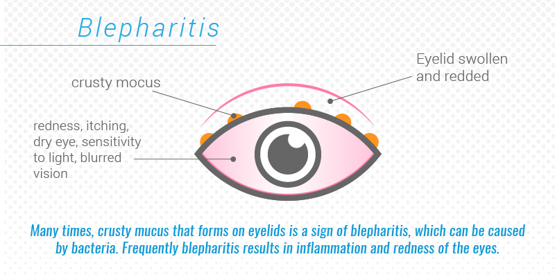 8 Types of Eye Discharge and How to Remedy It - Cliradex®