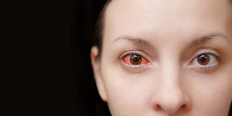 Dry Eye Syndrome- What It Is and What to Do About It