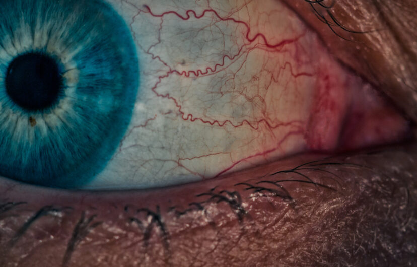 Eye Inflammation – The Hallmark of All Ocular Surface Disease