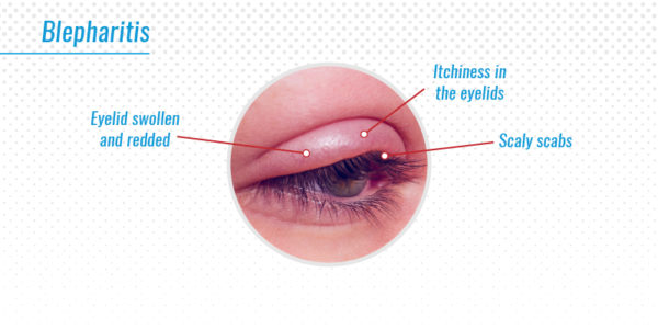 The Natural Way to Treat Demodex Blepharitis - Cliradex®